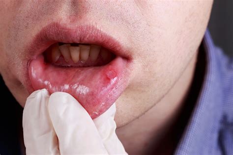7 Treatment Options For Canker Sores Heall