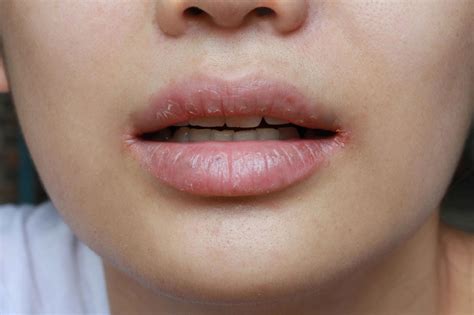 วิธีแก้ริมฝีปากแห้งมาก รักษาปากแตก เป็นร่อง ให้กลับมาชุ่มชื้นได้ง่าย ๆ