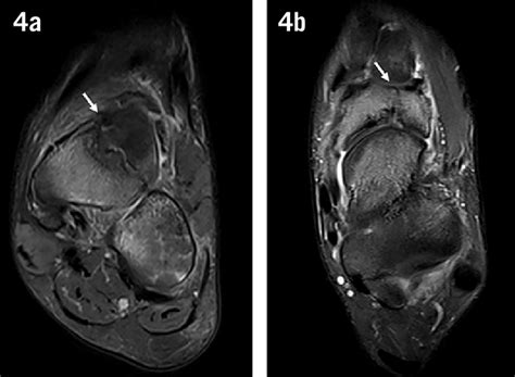 Tibial Stress Fracture Of The Anterior Cortex A Conventional