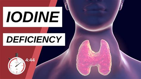 Iodine Deficiency Symptoms 10 Signs Of Iodine Deficiency Youtube