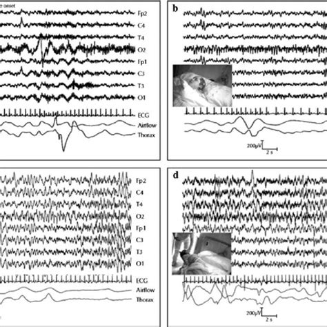 Periodic Lateralized Epileptiform Discharges Pleds Plus Pleds Plus