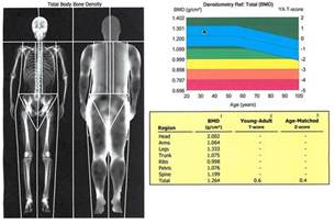 If you already have osteoporosis, bone scans can also tell you how fast the disease is progressing. My DEXA Scan for Body Composition - BJJ Caveman