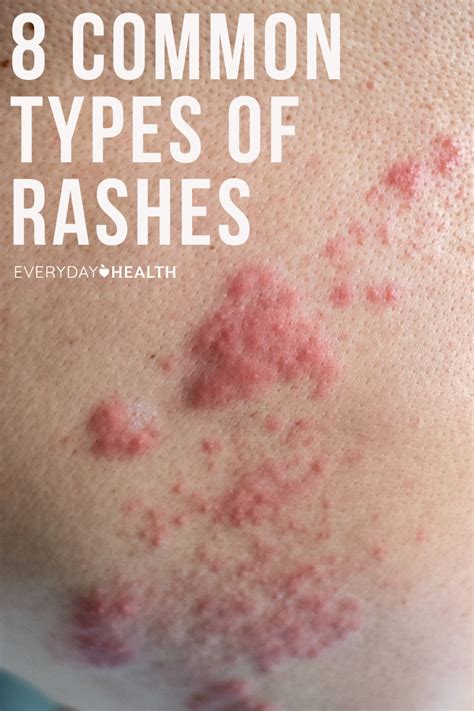 8 Common Types Of Rashes Types Of Rashes Rashes Common Skin Rashes