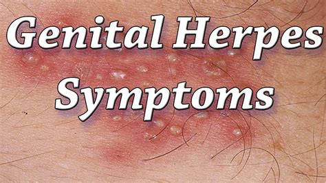 Genital Herpes Symptoms What Are The Common Symptoms Of Herpes Youtube