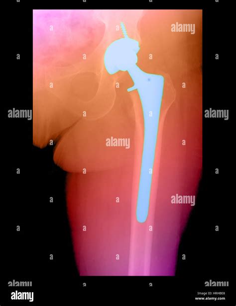 Acetabulum Fracture Hi Res Stock Photography And Images Alamy