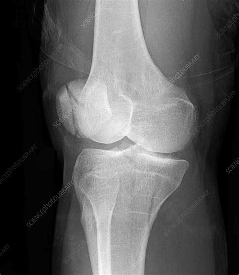 Tibial Plateau Fracture X Ray Stock Image F0360261 Science