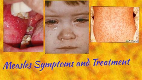 Measles Symptoms And Treatment Youtube