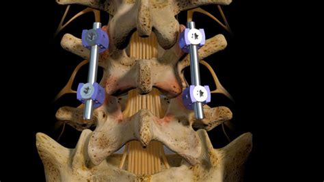 Lumbar Fusion Percutaneous Spinal Instrumentation Sa Spine