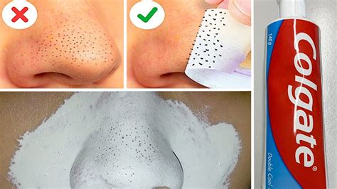 In Just 5 Mints Best Way To Remove Blackheads With Toothpaste