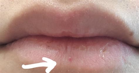 Small Bump On Lip Has Been Around For Months What Is It No Pain Or Discomfort Purely Visual