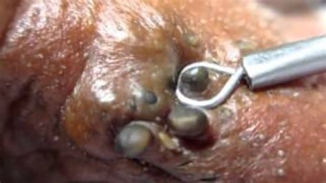 You may be able to find the same content in another format, or you may be able to find more information, at. *NEW* 2019 SATISFYING PIMPLE POPPING & BLACKHEAD REMOVAL ...