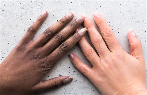 Bowen sickness looks like flaky, rosy patches that might be crusted; Subungual Melanoma Causes, Diagnosis, and Treatment