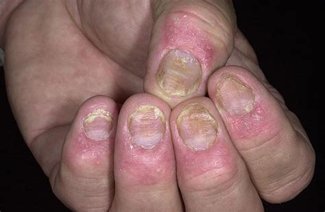 Псориазис на ноктите лечение Псориазис върху ноктите снимка