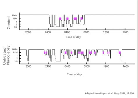 Understanding Narcolepsy Sleep Medicine