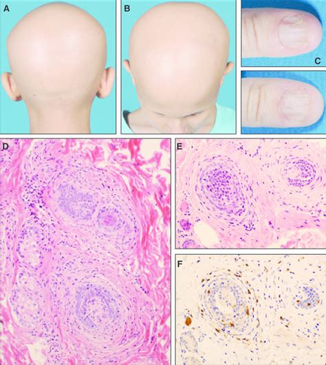 Alopecia Universalis And Nail Pitting In The Aps1 Patients A B