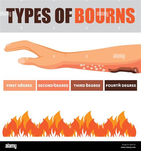 Skin Burn Injury Treatment And Stages Infographic Damage From Fire