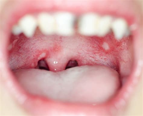 Infection Of Ulcer Inside Mouth Stock Photo Image Of Inside Girl