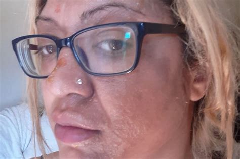 Woman Left With Horrific Facial Burns After Trying Out