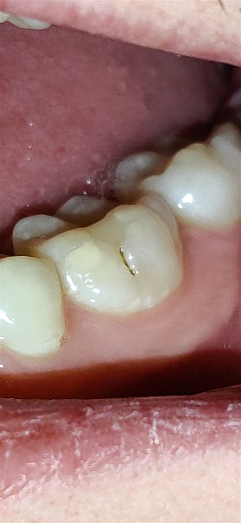 I Just Noticed A Strange Dark Spot On My Tooth Is It Tooth Decay
