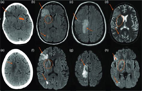 Multiple Ischaemic Strokes And Anoxic Encephalopathy A 35 Year Old