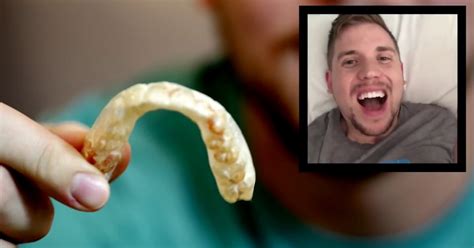 guy didn t know he could take out his retainers removes them for the first time in five years