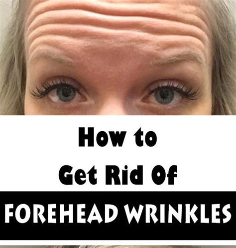 How To Get Rid Of Forehead Wrinkles Without Botox Wellness Topic