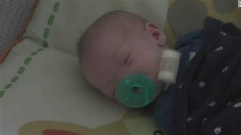 Miracle Baby Born Without A Nose Dies Cnn