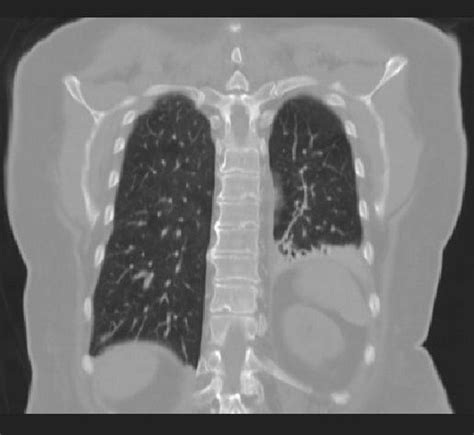 Coronal Section Of The Chest Ct Scan Showing Multiple Lung Metastases
