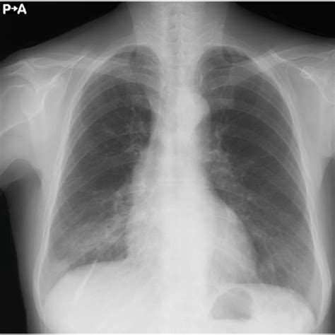 Chest Radiography Revealed Consolidation In The Right Lower Lung Field