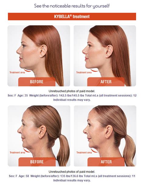 Kybella Orange County Chin Reduction Get Rid Of Your Double Chin