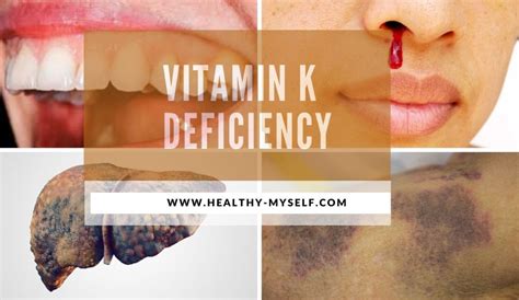 vitamin k deficiency causes symptoms sources andnatural remedies 2021