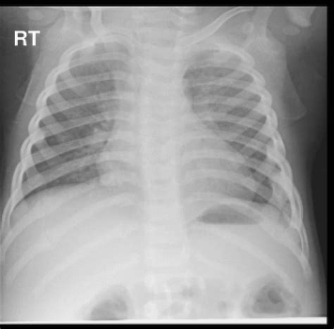 Full Text Rib Fractures Accidental Or Non Accidental International
