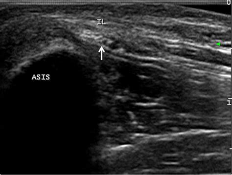 Transverse Ultrasound Image Shows The Nerve Passing Under The Inguinal