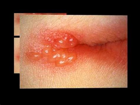 The world health organization estimates that 67 percent of all a man's penile microbiome could predict whether his female partner develops bacterial vaginosis, study. What Is The Meaning Of Skin Herpes? - YouTube