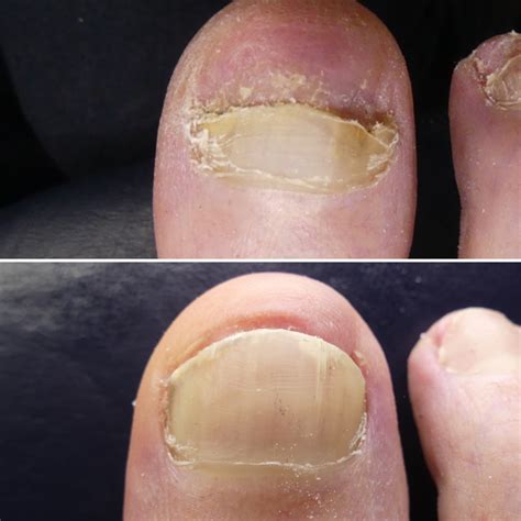 Lunula Laser For Fungal Nails Infinite Podiatry And Physio