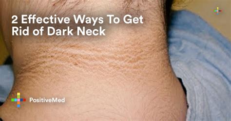 2 Effective Ways To Get Rid Of Dark Neck Positivemed