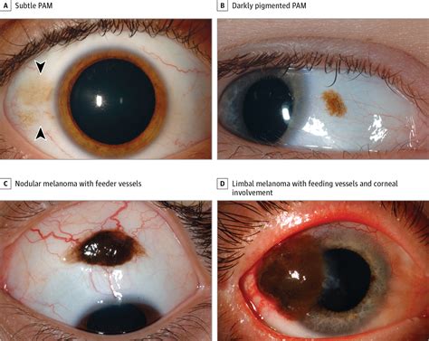 Clinical Features Of Benign Vs Malignant Conjunctival Tumors In