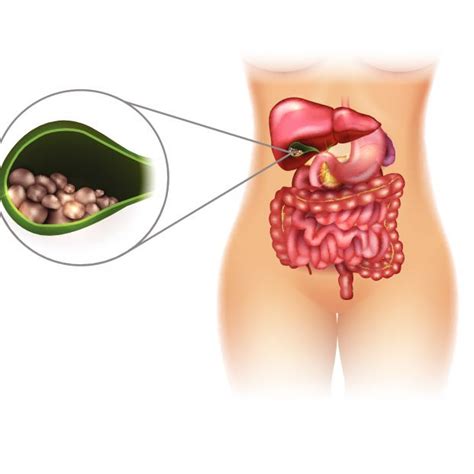Síntomas de las piedras en la vesícula