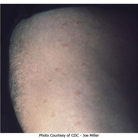 Pityriasis Rosea Stages Photos Treatments