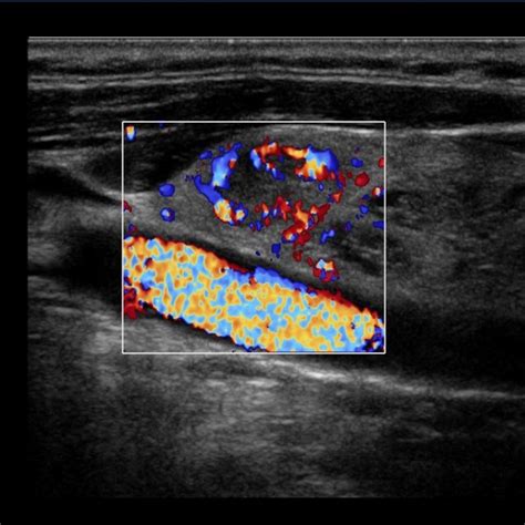 Colour Doppler Image Of Malignant Thyroid Nodule Show Increased And