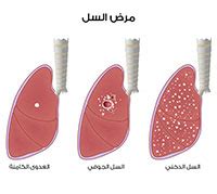 Primary pulmonary tuberculosis is seen in patients not previously exposed to mycobacterium tuberculosis. السل - اسباب , اعراض و علاج مرض السل - ويب طب