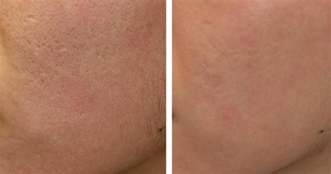 Large Pores Southern Cosmetic Laser Charleston Botox Massage And