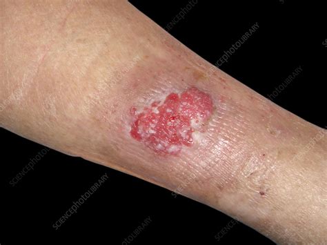 Squamous Cell Carcinoma On A Womans Leg Stock Image C0583150
