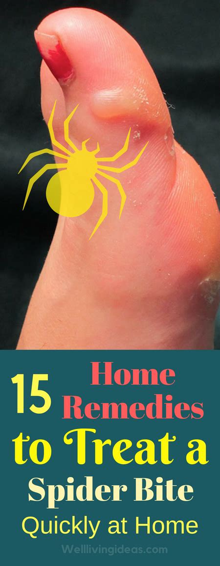 15 Home Remedies To Treat A Spider Bite Quickly At Home Spider Bites