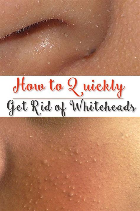 12 Home Remedies To Get Rid Of Whiteheads Whiteheads Beauty Hacks Skin