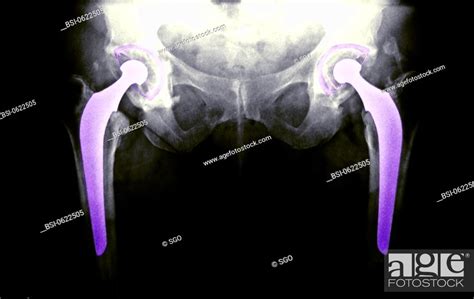Hip Prosthesis X Ray Total Hip Replacement Frontal X Ray Of Hips