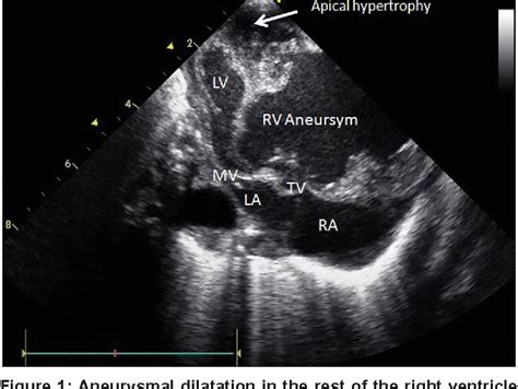 Figure 1 From Unusual Right Ventricle Aneurysm And Dysplastic Pulmonary