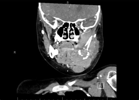 Medulloblastoma With Metastasis To The Jaw In A Child With Nevoid Basal