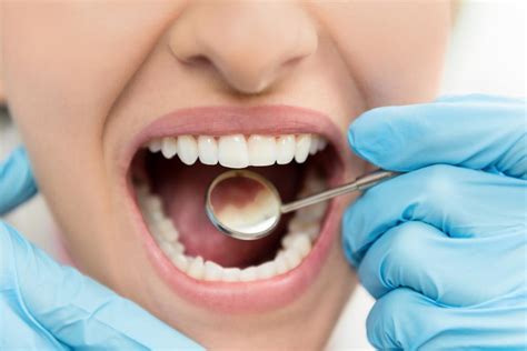 But if you never bother to see a dentist until a problem arises, your teeth might be screaming for help. How to get rid of cavities: Home remedies & prevention