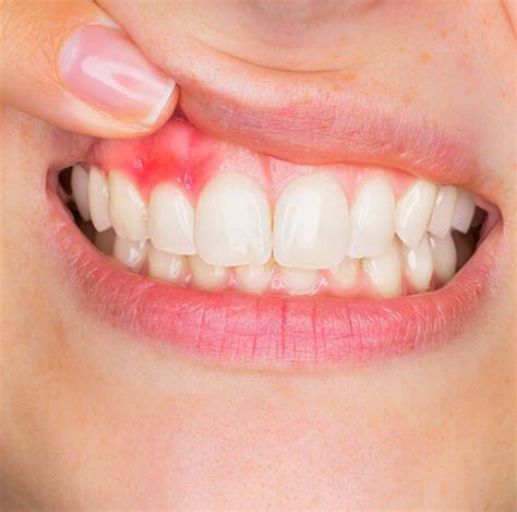 Swollen Gums 9 Possible Causes And Best Way Of Treatments